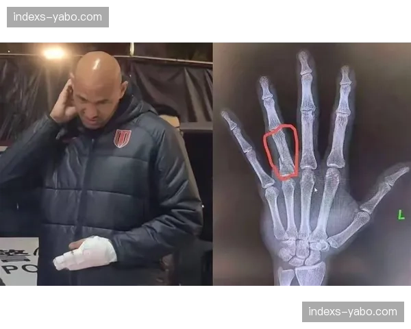 蓉城费利佩手指骨折术后训练 记者透露其状态很难达到百分百水平